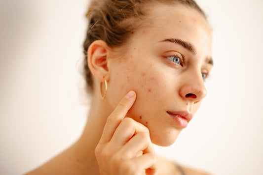 Young woman with acne touching her cheek, close-up skincare and acne treatment concept