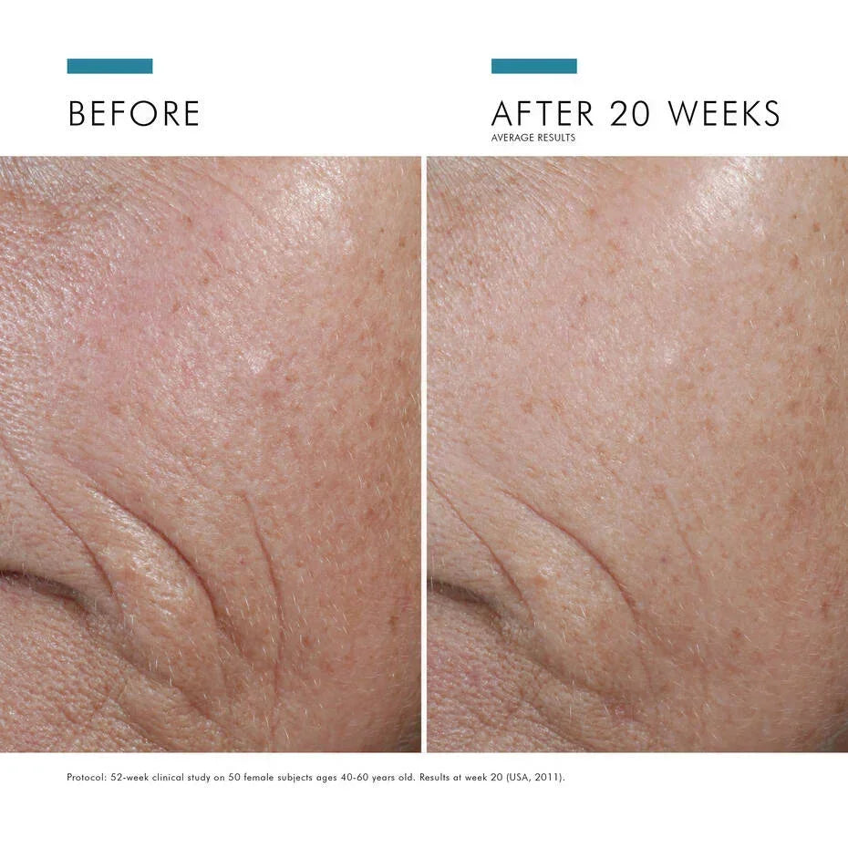 Close-up before and after photos showing reduced wrinkles and improved skin texture after 20 weeks