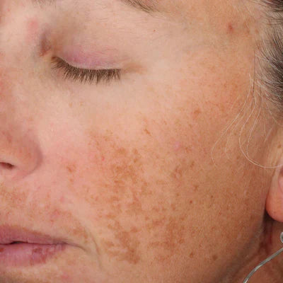 ALASTIN A-LUMINATE Brightening Serum® 50mL clinical result before image two