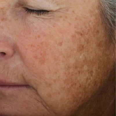 ALASTIN A-LUMINATE Brightening Serum® 50mL clinical result before image one