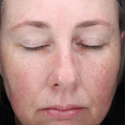ALASTIN C-Radical Defense Antioxidant Serum 29mL clinical result after image one