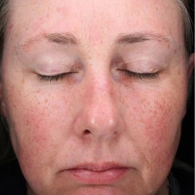 ALASTIN C-Radical Defense Antioxidant Serum 29mL clinical result before image one
