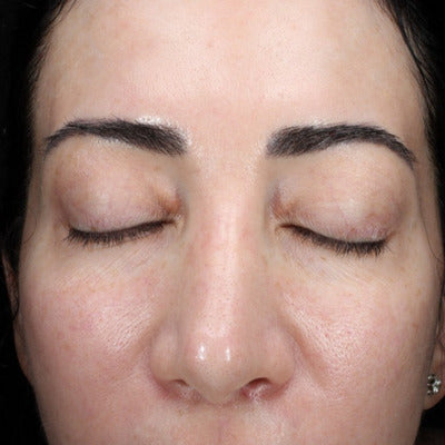ALASTIN HA IMMERSE Serum® 30mL clinical result after image two