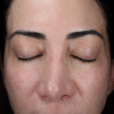 ALASTIN HA IMMERSE Serum® 30mL clinical result before image two