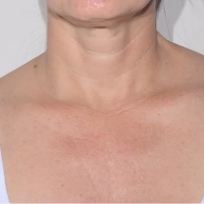 ALASTIN Restorative Neck Complex 50mL clinical result after image two