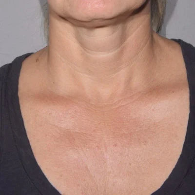 ALASTIN Restorative Neck Complex 50mL clinical result before image two