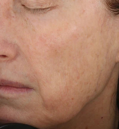 ALASTIN Restorative Skin Complex with TriHex+™ 29mL clinical result after image