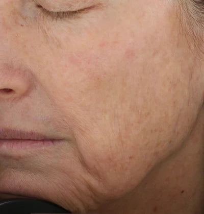 ALASTIN Restorative Skin Complex with TriHex+™ 29mL clinical result before image