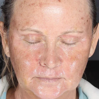 ALASTIN Skin Nectar with TriHex Technology® 29mL clinical result after image one
