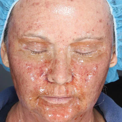 ALASTIN Skin Nectar with TriHex Technology® 29mL clinical result before image one
