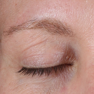 ALASTIN Restorative Eye Complex 18mL clinical result before image two