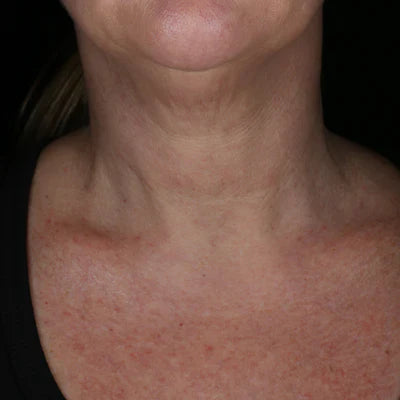 ALASTIN Restorative Neck Complex 50mL clinical result after image one