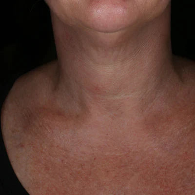 ALASTIN Restorative Neck Complex 50mL clinical result before image one
