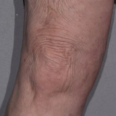 ALASTIN TransFORM Body Complex™ 170g clinical result after image two