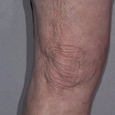 ALASTIN TransFORM Body Complex™ 170g clinical result before image two