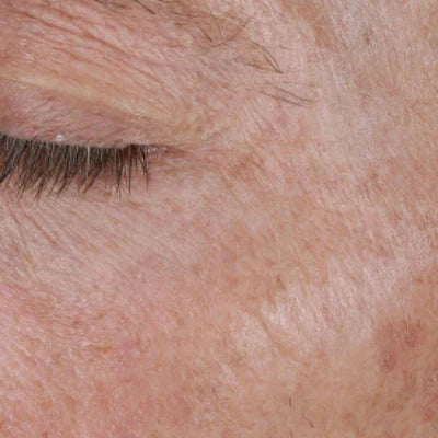 ALASTIN Restorative Eye Complex 18mL clinical result after image one