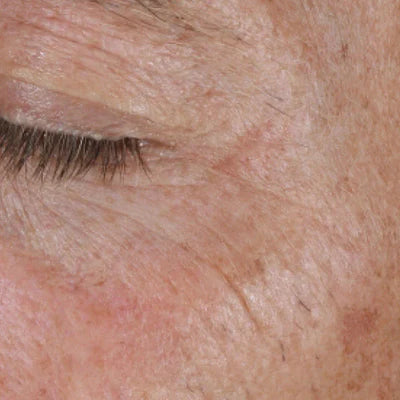 ALASTIN Restorative Eye Complex 18mL clinical result before image one