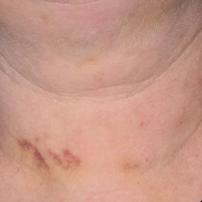 ALASTIN INHANCE® Serum 10mL clinical result after image one