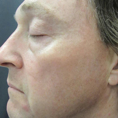 ALASTIN Skin Nectar with TriHex Technology® 29mL clinical result after image two