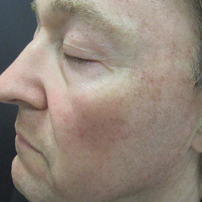 ALASTIN Skin Nectar with TriHex Technology® 29mL clinical result before image two