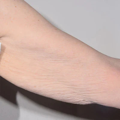 ALASTIN TransFORM Body Complex™ 170g clinical result before image one